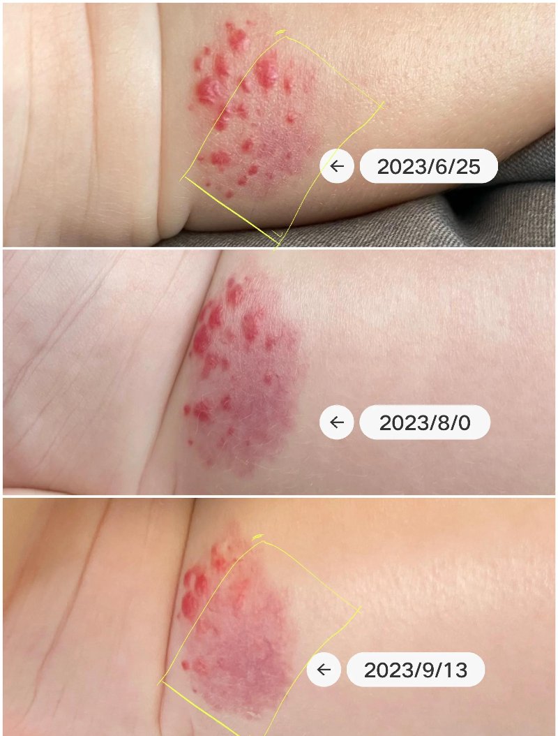 宿迁血管瘤
